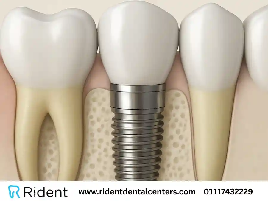مراحل زراعة الاسنان